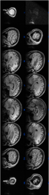 My MRI here